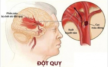 Xử trí đúng cách khi bị đột quỵ não
